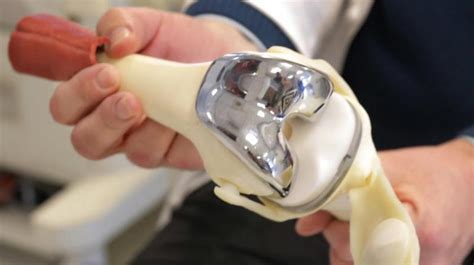 Women More Sensitive To Metal Used In Joint Replacement