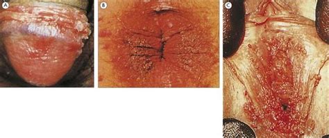can anal warts cause cancer excellent porn