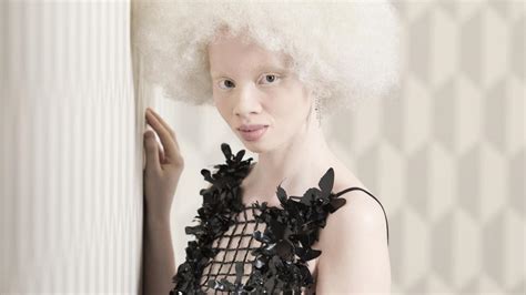 Albinismus Nirgendwo So Verbreitet Wie In Südafrika Welt