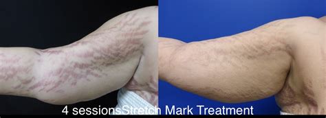 Patient 24560994 Stretch Mark Removal Gallery Before And After Photos