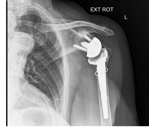 figure 2 from reverse shoulder arthroplasty for the treatment of three