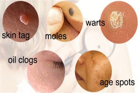 use these tested unique and natural ways to treat moles
