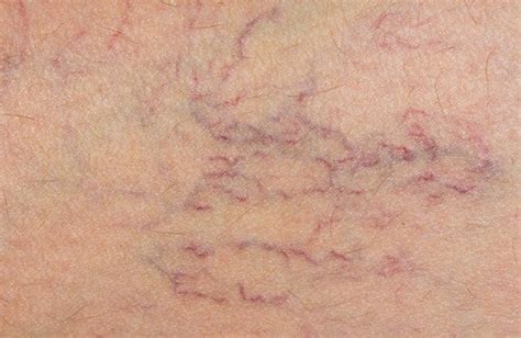 natural treatment to prevent varicose veins step to health