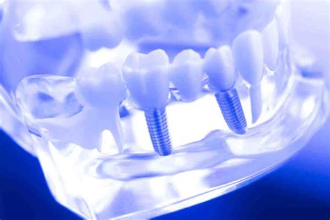 teeth dental implants cost dental news network