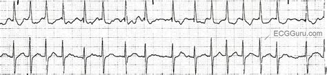 ecg basics atrial fibrillation   rapid ventricular response ecg