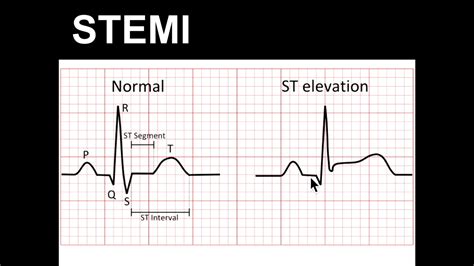 st elevations monitoring  infarction stemi electrocardiogram ecg ekg