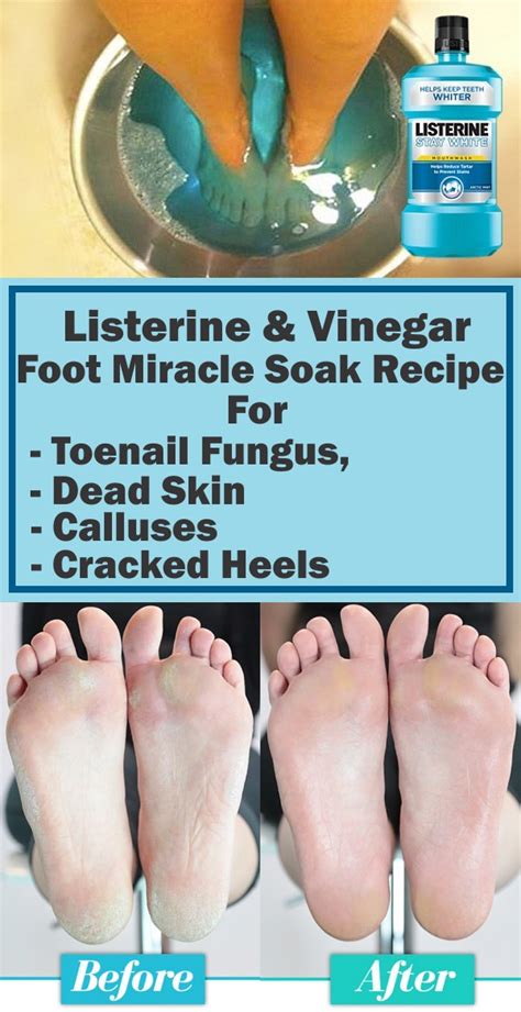listerine vinegar foot miracle soak recipe  toenail fungus dead