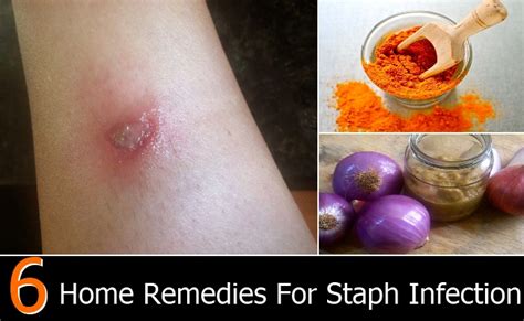 treatment  bacterial vag