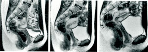 Magnetic Resonance Imaging Of Male And Female Genitals During Coitus