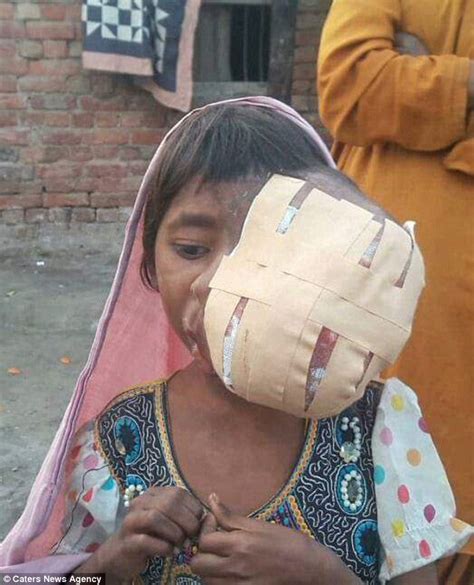 Pakistan Girl Has A Football Sized Facial Tumour Daily