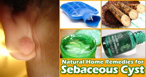 12 natural home remedies for sebaceous cyst