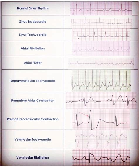 printable ekg strips   practice tests graded quizzes coaching