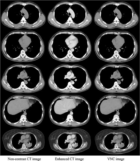 frontiers generation  virtual  contrast ct  intravenous enhanced ct  radiotherapy