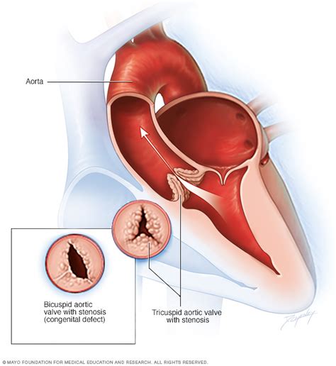 Aortic Valve Stenosis Disease Reference Guide