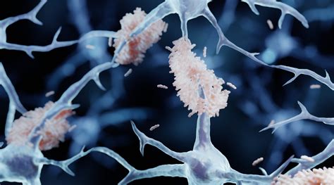 questionable data jeopardizes alzheimers amyloid theory