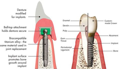 dental implant faqs forest smiles