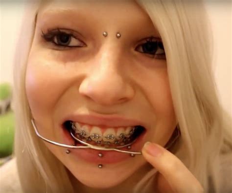 Braces Girls Cute Braces Teeth Implants Dental Implants Lingual