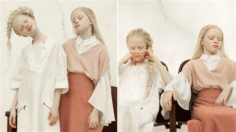 stunning twin teens  albinism  modeling industry  storm allure
