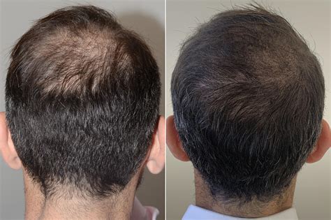 Hair Transplants For Men Pictures Miami Fl Paciente 59563