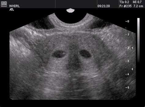Retroverted Uterus Pregnancy After Pregnant