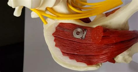wireless implant heals damaged nerves    destructs