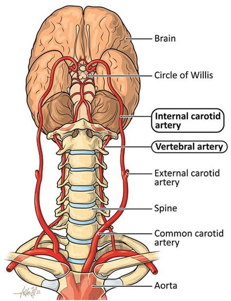 Cervical Artery Dissection Cead Treatment And Diagnosis Uh