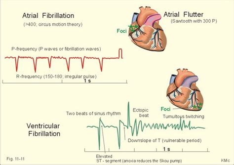 cardiac action potentials and disorders mednote dk