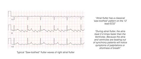 atrial flutter ablation melbourne heart rhythm