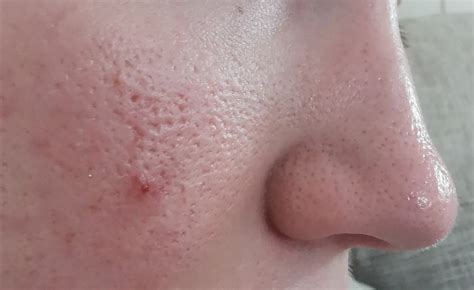 severely enlarged pores general acne discussion acneorg