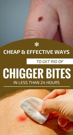 treat chigger bites personal care remedies  mosquito bites top  home remedies