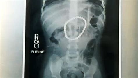 3 Year Old Swallows 37 Buckyball Magnets Survives Cbs News