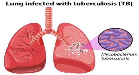 World Tb Day 2018 Can Tuberculosis Be Cured