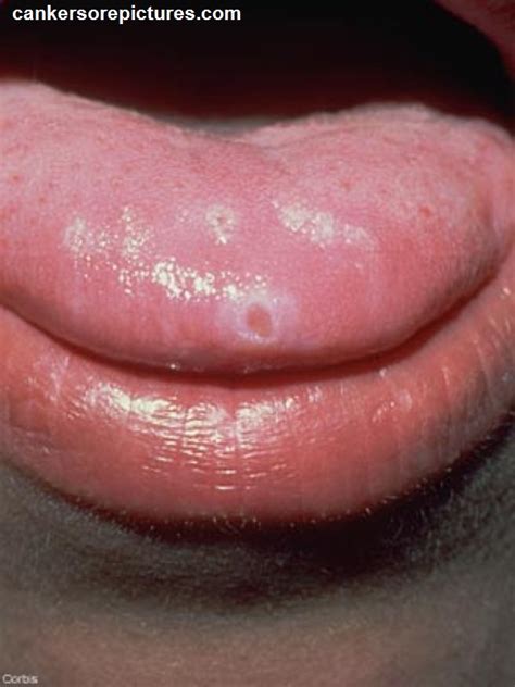 rwee406rib herpes mouth ulcers