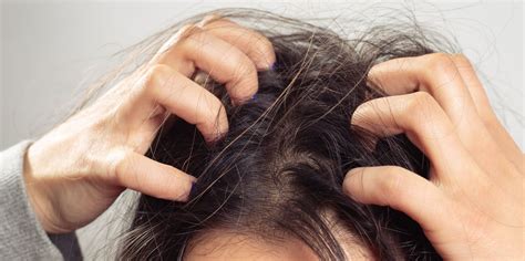 common   treatments   itchy scalp