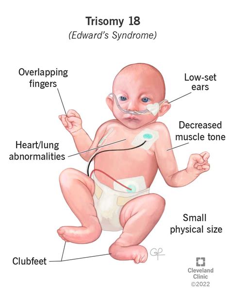 edwards syndrome feet