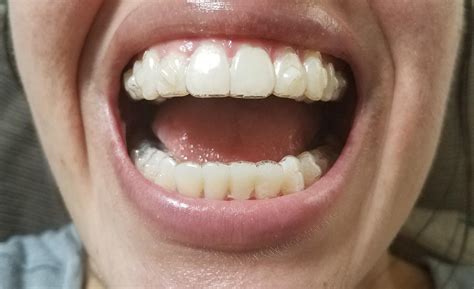 teeth tracking properly invisalign