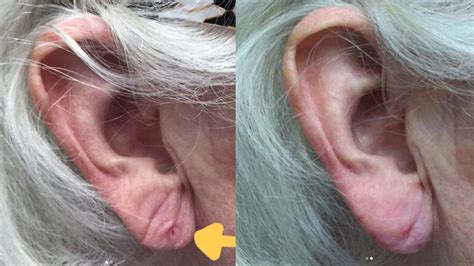 Earlobe Fillers Are On The Rise Allure