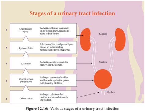 Urinary Tract Infections Medical Microbiology