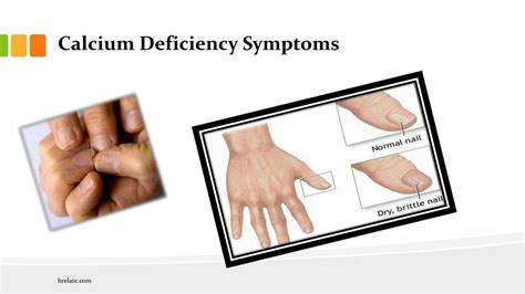 calcium deficiency symptoms iski  ko pehchane powerpoint  id