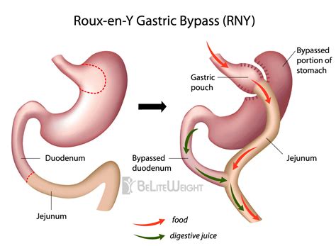 Roux En Y Gastric Bypass Type 2 Diabetic Weight Loss