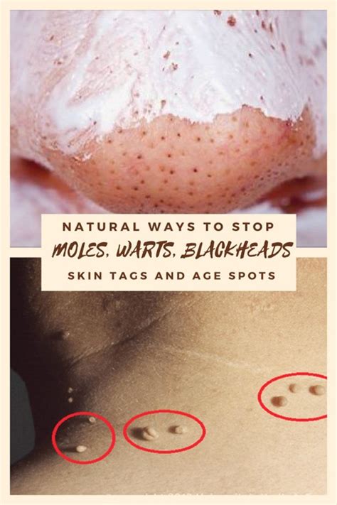 skin tag natural home remedies warts