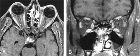 Orbital Lyme Disease Mr Imaging Before And After Treatment Case