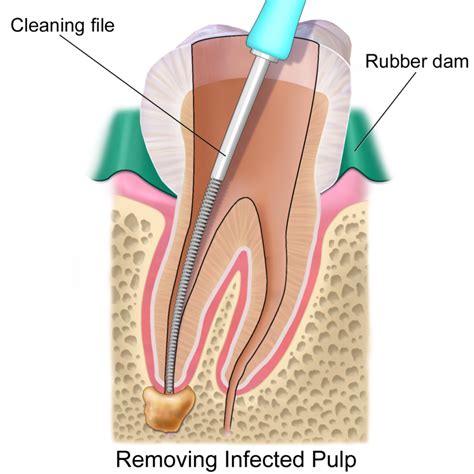 root canal woodcrest dental