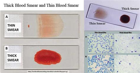 thick blood smear  thin blood smear