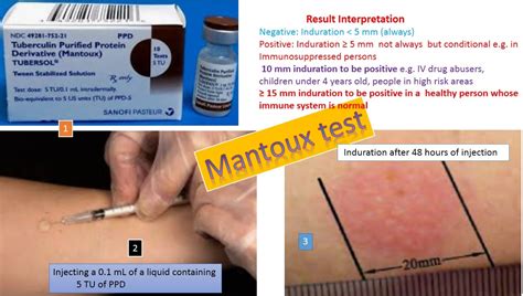 tuberculin skin test introduction procedure normal range  result