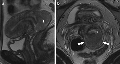 exophytic cervical cancer stage ib2 a sagittal t2 weighted image