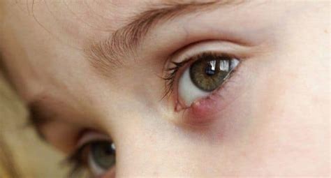 stye remedies and tips you can try read health related