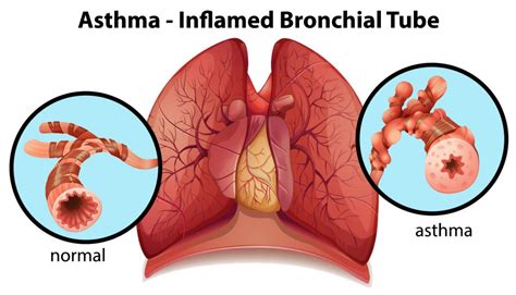 severe asthma  children pediatric pulmonologists  plano