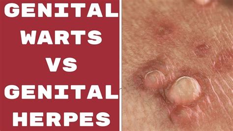 genital warts vs genital herpes genital herpes research genital warts infections youtube