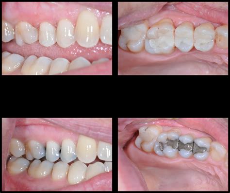 dental filling cavity fillings tooth decay